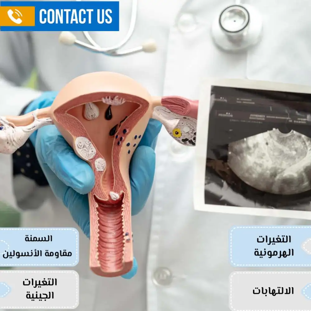 أسباب تكيس المبايض